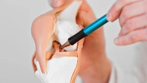 quanto tempo de muleta apos cirurgia lca descubra